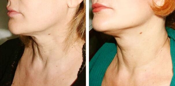 photos before and after laser skin rejuvenation 1