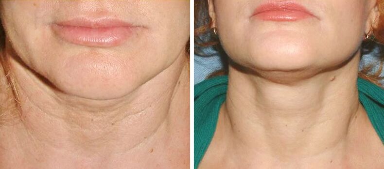 photos before and after laser skin rejuvenation 2