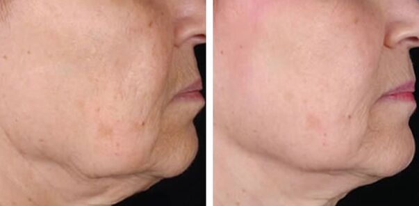 photos before and after laser skin rejuvenation 3