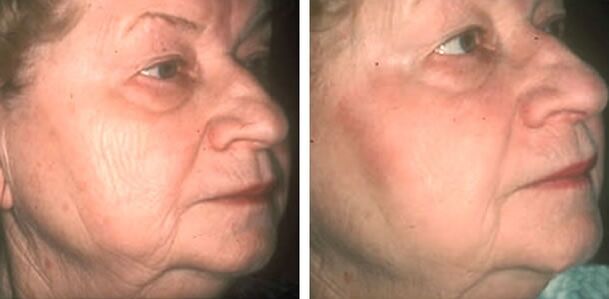 photos before and after laser skin rejuvenation 4