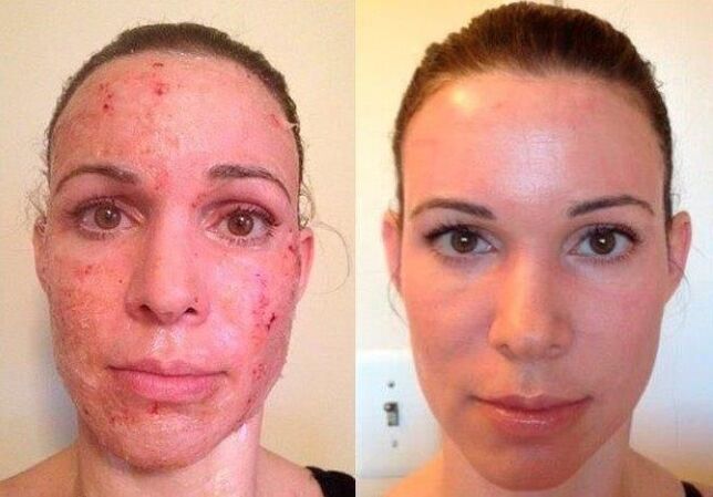 before and after skin rejuvenation fraction photo 1