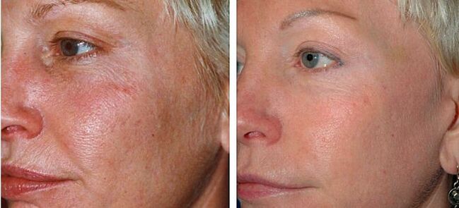 photo before and after fractional skin rejuvenation 4