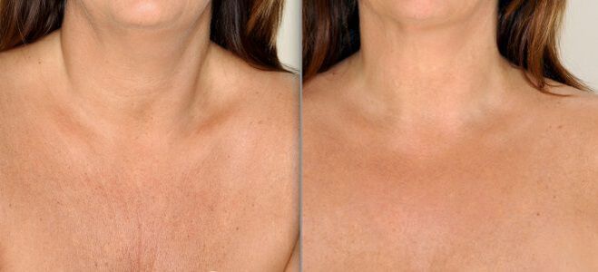 photos before and after fractional skin rejuvenation 2