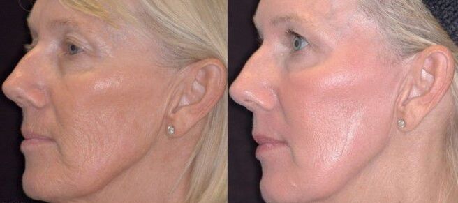 photos before and after fractional skin rejuvenation 3