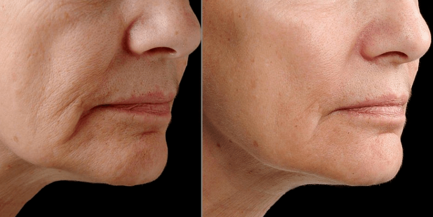 Laser Fractional rejuvenation - Effect