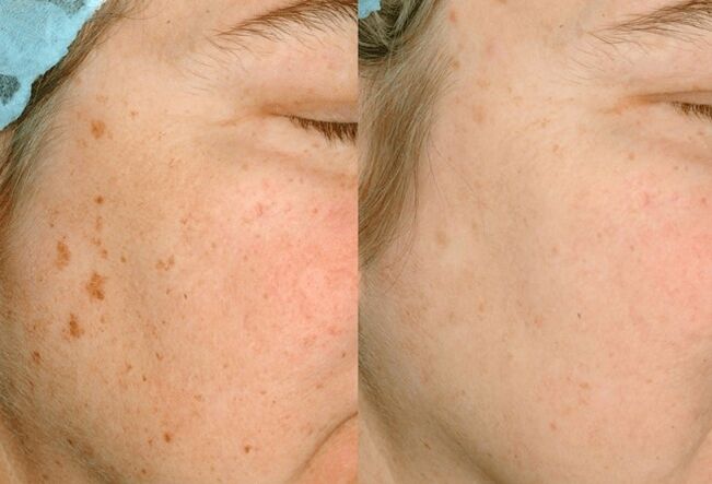 Removes pigmentation on the skin
