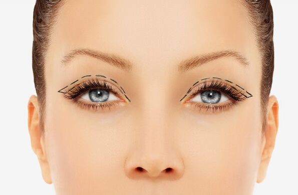 The eyelid line